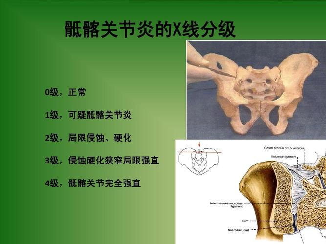 周围关节型的强直性脊柱炎