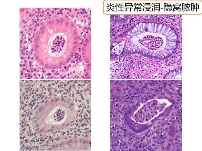 溃疡性结肠炎是什么原因引起的