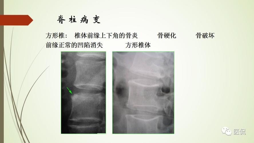 强直性脊柱炎后期表现