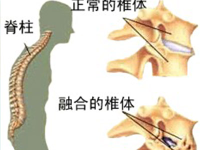 强直性脊柱炎活动期可拄拐吗