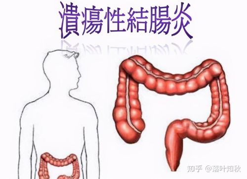 欧洲得溃疡性结肠炎能治好吗