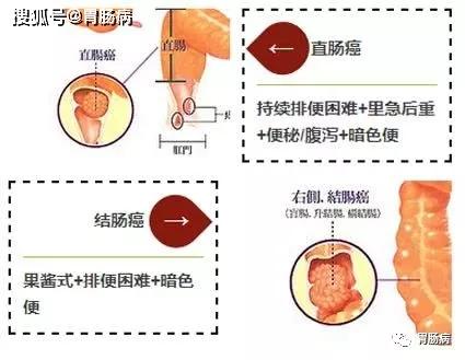 溃疡性结肠炎粪便图片