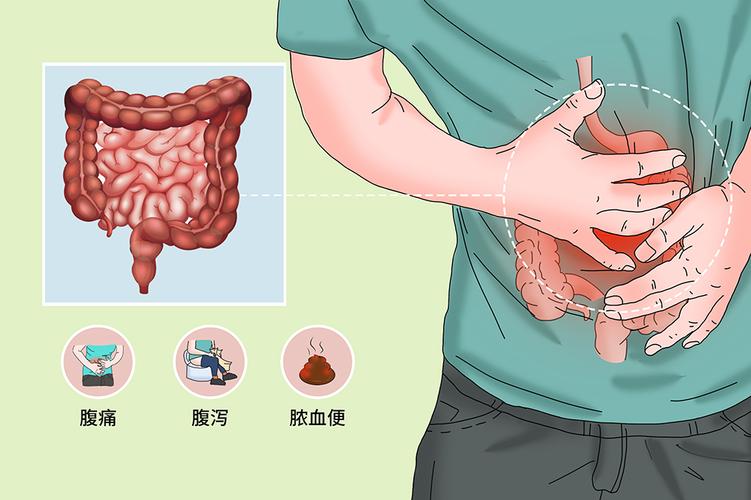 溃疡性结肠炎肠道狭隘是怎么回事