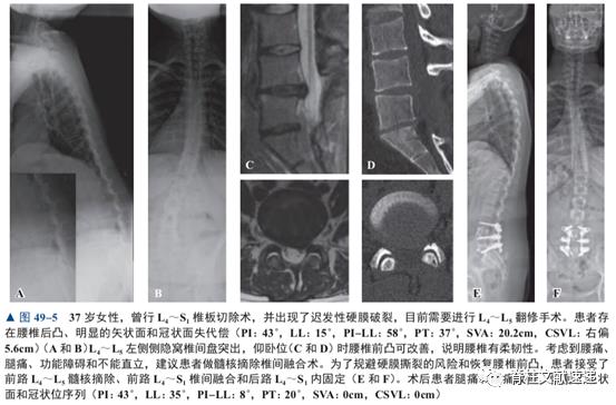 强直性脊柱炎骶骨ct解读