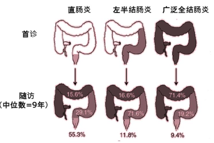 溃疡性结肠炎怎么样引起的