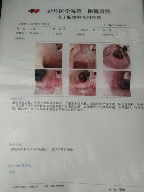 哪能治溃疡性结肠炎