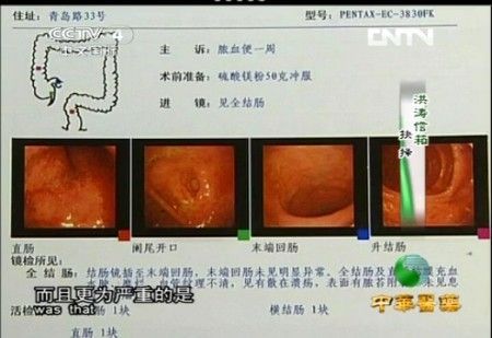 溃疡性结肠炎最重要检查方法