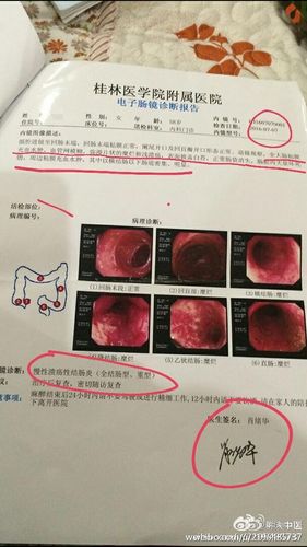 溃疡性结肠炎能吃山药