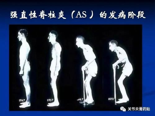 强直性脊柱炎手指疼痛吗