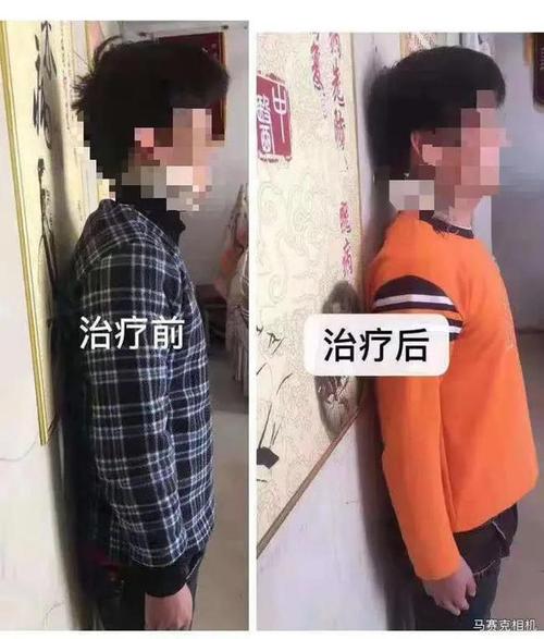 胡氏老黑膏治强直性脊柱炎