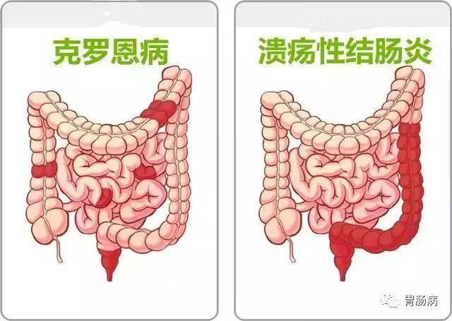 溃疡性结肠炎病变吗