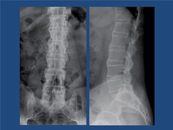 强直性脊柱炎抬腿疼么