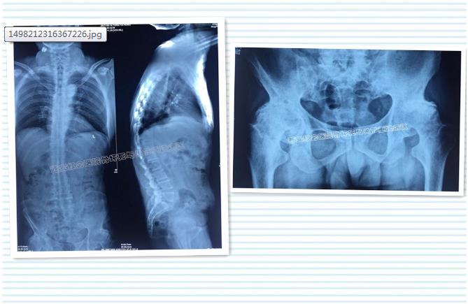 强直性脊柱炎12年髋关节痛