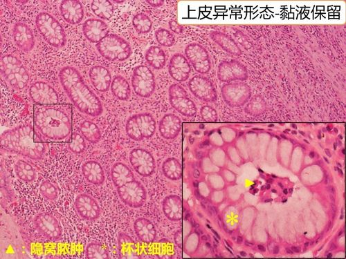 溃疡性结肠炎隐窝脓肿