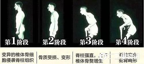 脊柱痛怎么治疗强直性脊柱炎