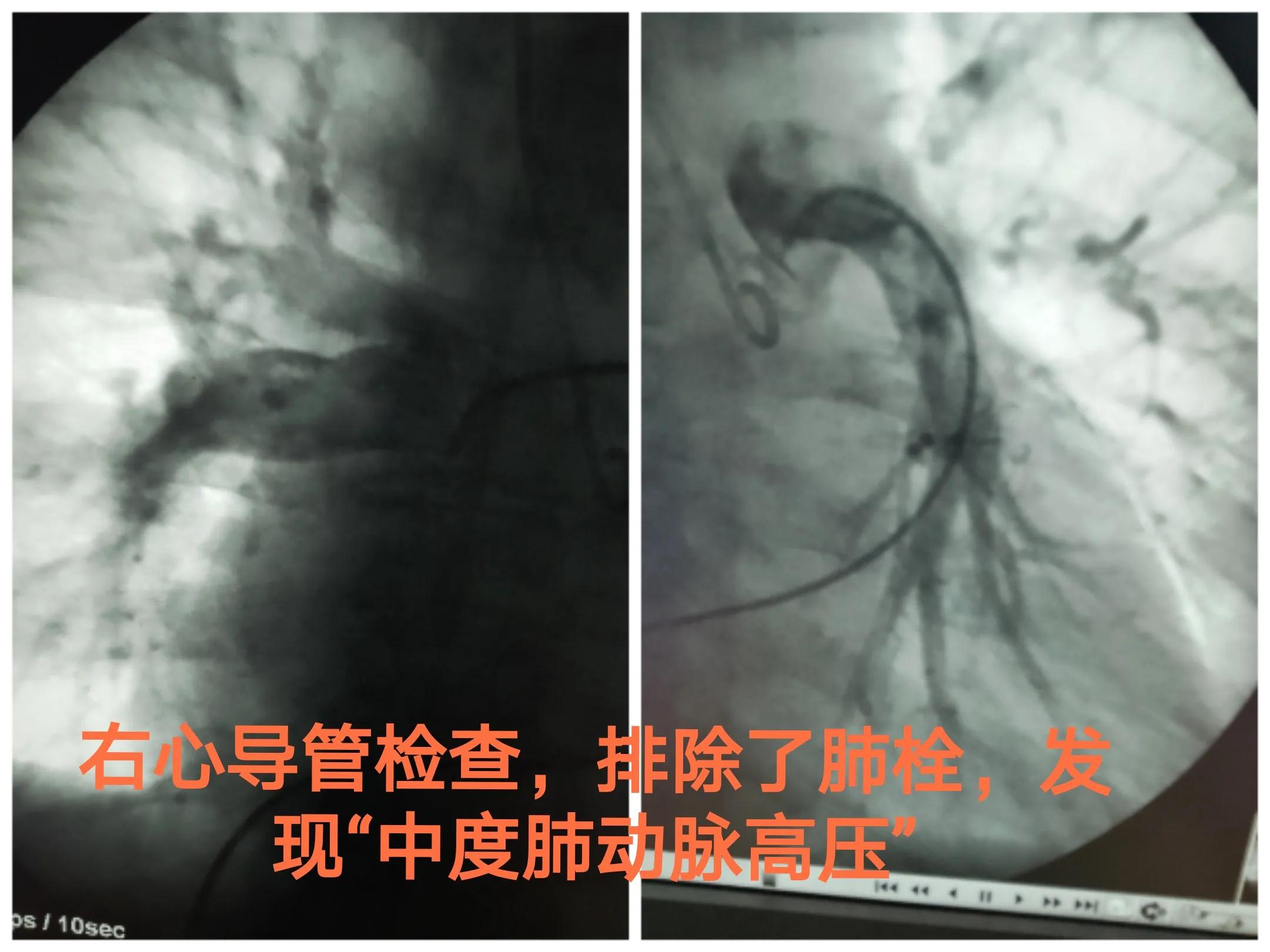 今天，我心脏科医生给一个女病人用了“伟哥”—