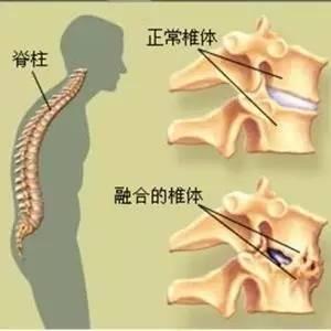 强直性脊柱炎饮食禁忌