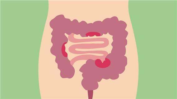 刚怀孕溃疡性结肠炎复发了