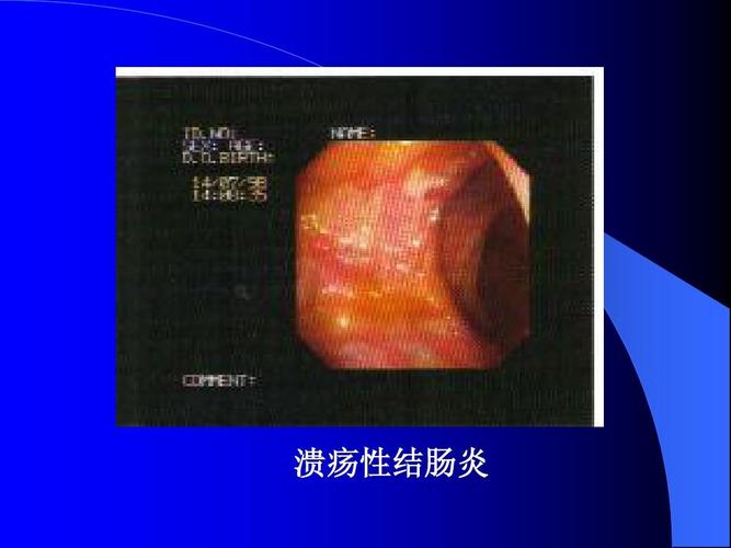 大鼠溃疡性结肠炎dss模型