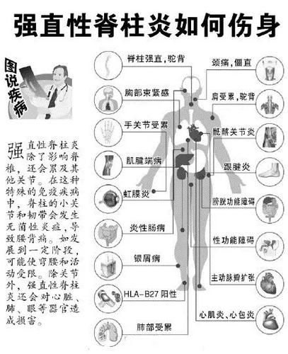 名医治强直性脊柱炎