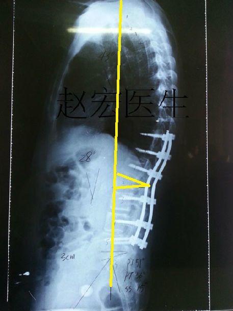 强直性脊柱炎驼背会压迫心脏吗