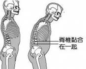 小孩强直性脊柱炎确诊条件