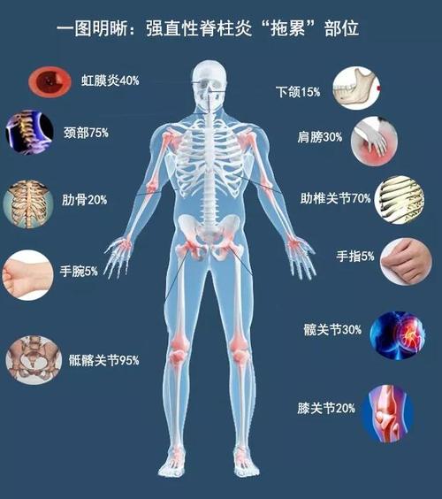 强直性脊柱炎弯腰胸口疼