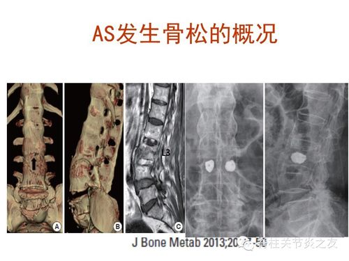 强直性脊柱炎可以检查什么