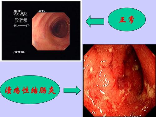 不溃疡能排除溃疡性结肠炎吗