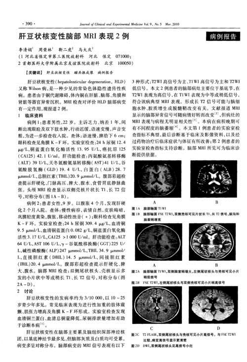 肝豆状核变性