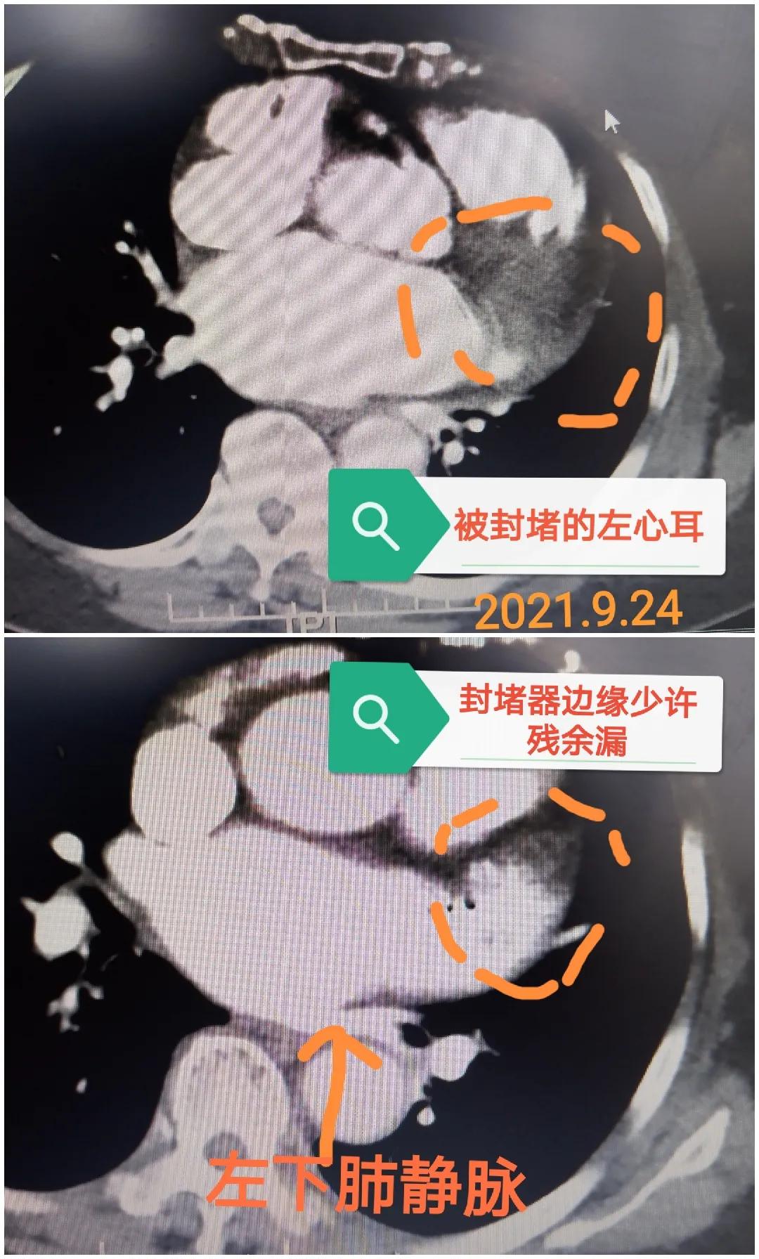 今天，我心脏科医生给一个女病人用了“伟哥”—