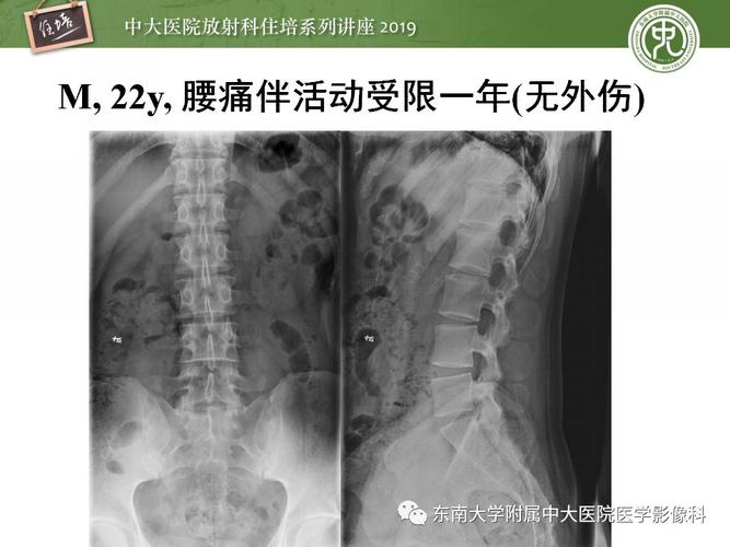 强直性脊柱炎中期典型x线表现