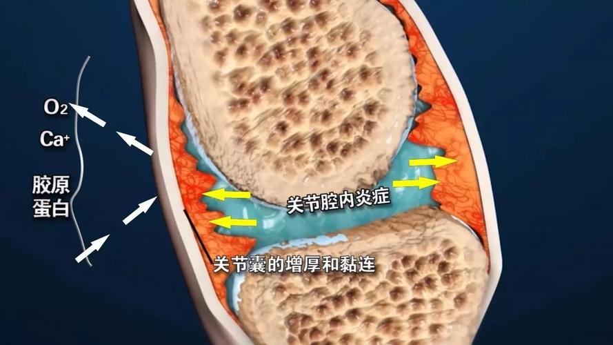 强直性脊柱炎打生物制剂会止疼不