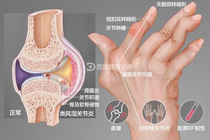 牛皮癣关节病和强直性脊柱炎区别