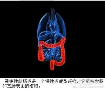 ?溃疡性结肠炎直肠型一定会进展吗