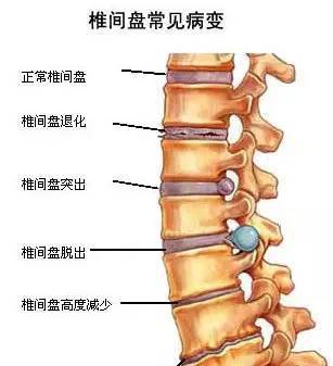 强直性脊柱炎与脊柱结核