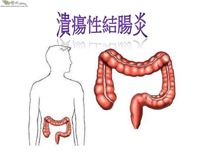 医生怀疑溃疡性结肠炎应该怎么办