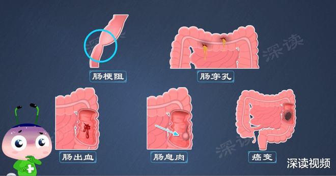 玉米棒的芯子能治溃疡性结肠炎吗