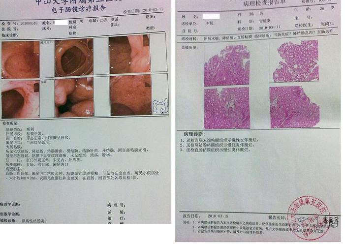 溃疡性结肠炎肚子咕咕叫大便正常为什么