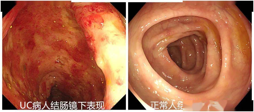 中度溃疡性结肠炎会癌变吗