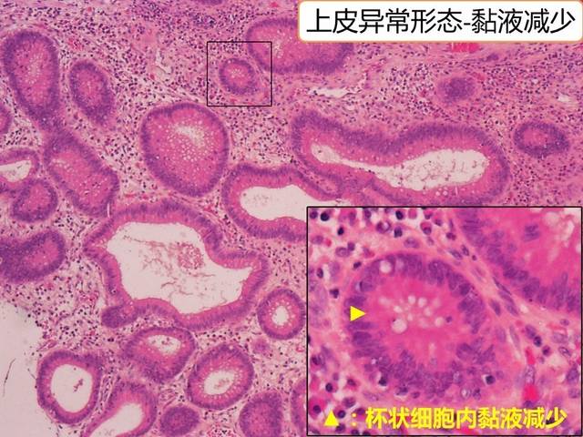 溃疡性结肠炎老排粘液