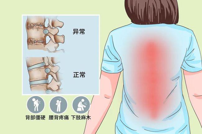 强直性脊柱炎病情活跃期