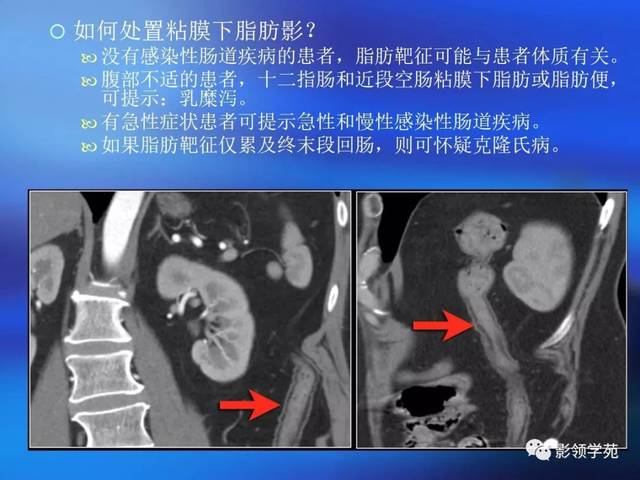 溃疡性结肠炎ct诊断结果