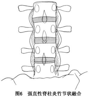 强直性脊柱炎活动期骶髂关节疼