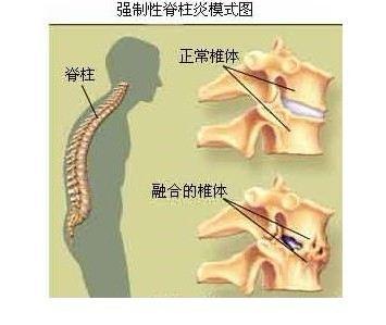 脚指炎与强直性脊柱炎关系