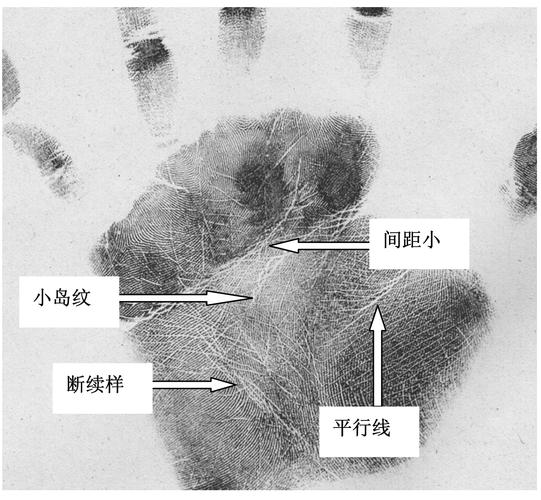 溃疡性结肠炎胳膊肉松