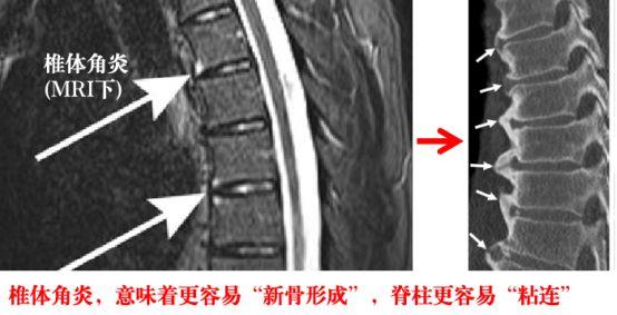 强直性脊柱炎生物剂打多久