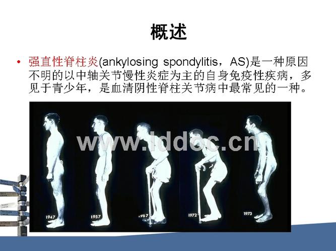 假性型强直性脊柱炎