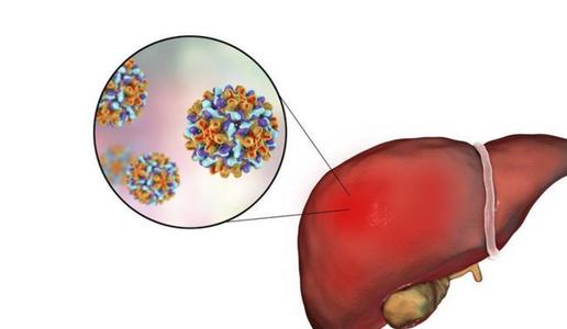 丁型肝炎
