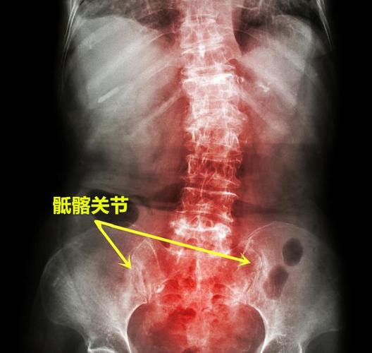 男友患强直性脊柱炎